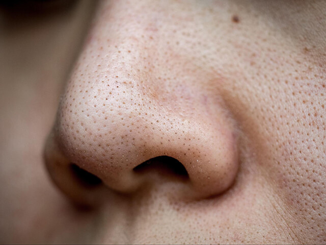 いちご鼻の効果的な治し方を詳しく解説！鼻の毛穴が目立たなくなる人が続出している！？
